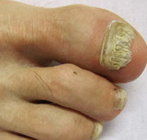 Onychomycosis